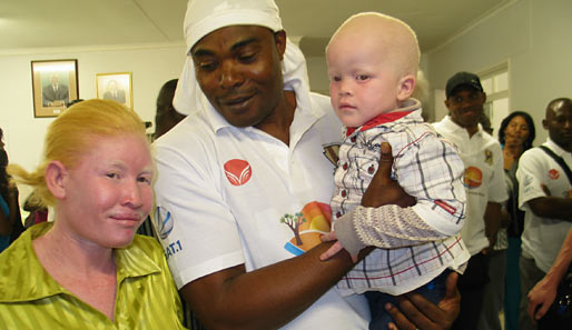In Otavi werden die verarmten Familien auch mit Hilfe von Ohorongo Cement medizinisch unterstützt. Unter anderem werden auch Albino-Familien behandelt