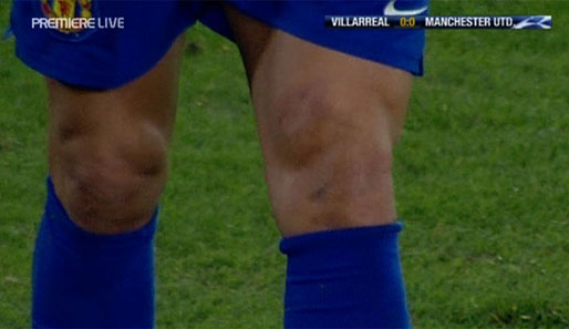 Die Blessur am linken Knie ist deutlich zu erkennen. Dennoch hielt Ronaldo bis zum Schluss durch. Endstand: 0:0