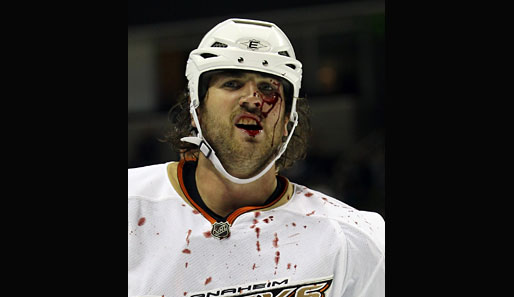 Deutliche Kampfspuren im Gesicht von Aaron Voros. Im Pre-Season-Duell der Anaheim Ducks gegen die San Jose Sharks gab es ordentlich was auf die Mütze