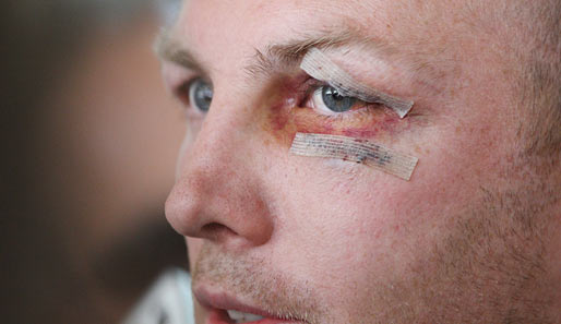 Autsch! Berufsrisiko für einen Rugby-Spieler wie Darren Lockyer, aber dieses Auge sieht dann doch arg lädiert aus