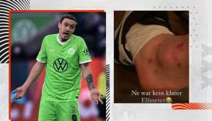 Max Kruse präsentierte auf Instagram seinen lädierten Knöchel.